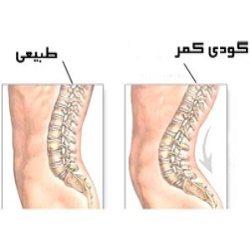 کدام تشک برای گودی کمر مناسب است؟